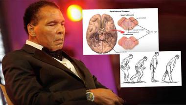 ما هو مرض "الباركنسون" الذي قضى على محمد علي؟