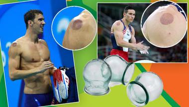 الحجامة النبوية.. طريقة علاج الرياضيين الأميركيين في الأولمبياد!